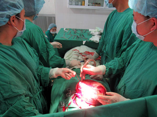 : Các bác sỹ tiến hành hút dịch trong khối u và giải phóng khối u khỏi ổ bụng.