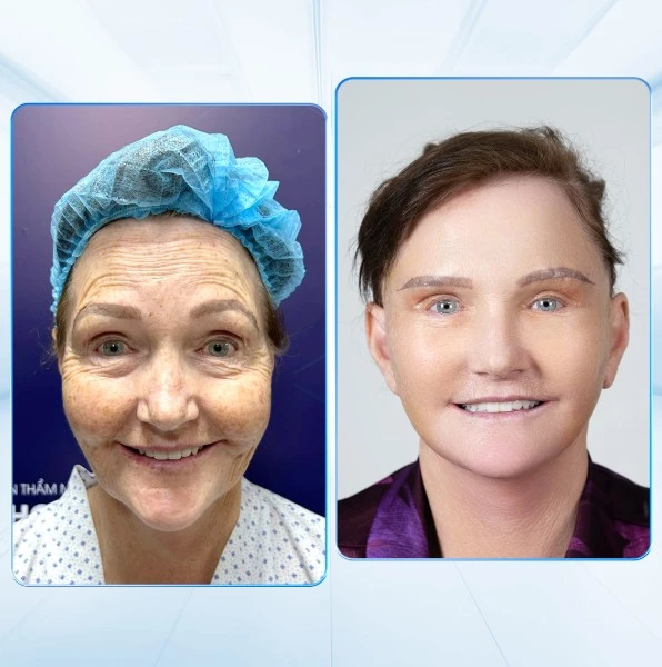 Khách hàng Quốc Tế thực hiện căng da mặt Deep Plane.