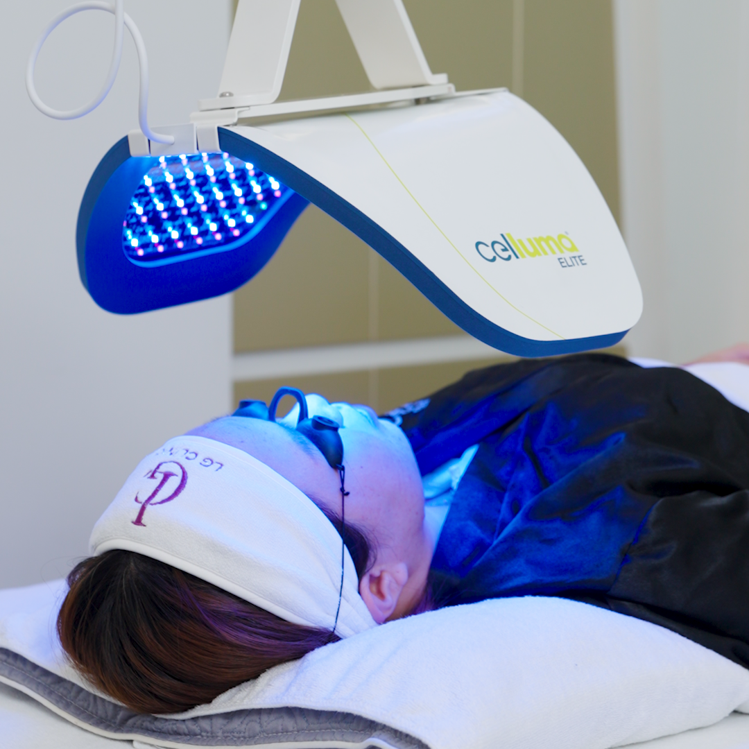 Ứng dụng công nghệ Celluma trong điều trị sẹo rỗ