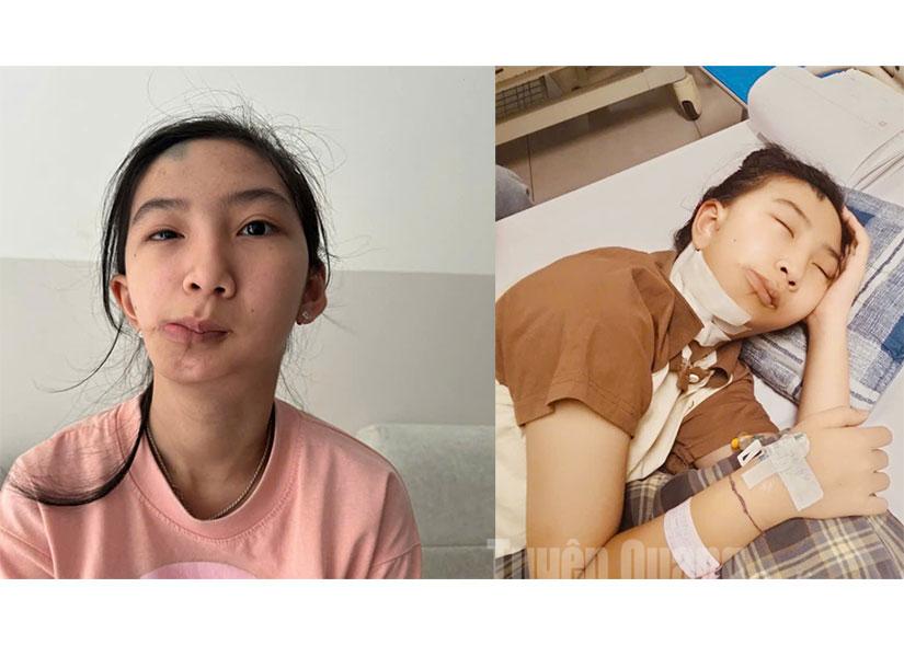 Khuôn mặt ban đầu của em Lê Anh Thư, thôn Mục Lạn, xã Tân Quang, tỉnh Tuyên Quang và em đang được điều trị tại Khoa Sọ mặt và Tạo hình, Bệnh viện Nhi Trung ương -Hà Nội.