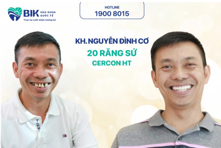 Hình ảnh khách hàng sau khi bọc răng sứ tại Nha Khoa Quốc Tế BIK