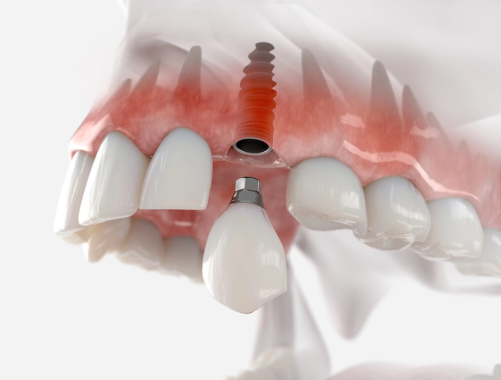 Kỹ thuật cấy ghép Implant